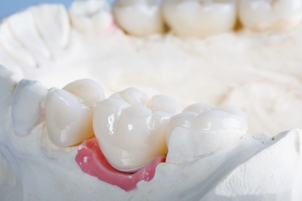 Coronas dentales Beniel | De la Torre Clínica Dental