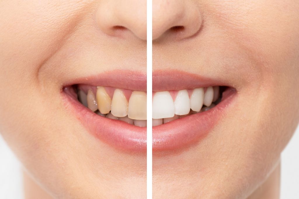 Blanqueamiento Dental - Beniel | De la Torre Clínica Dental